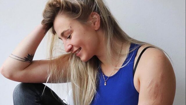 Instagram weigert foto's van Kenza vanwege littekens