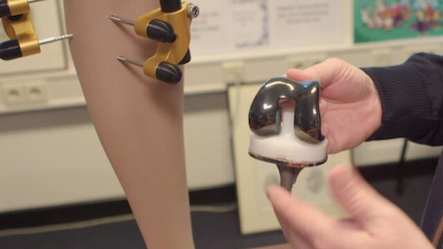 Herstel kraakbeen als succesvol alternatief voor knieprothese