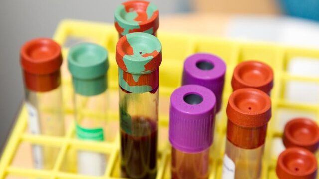 Een zeldzame ziekte én hiv