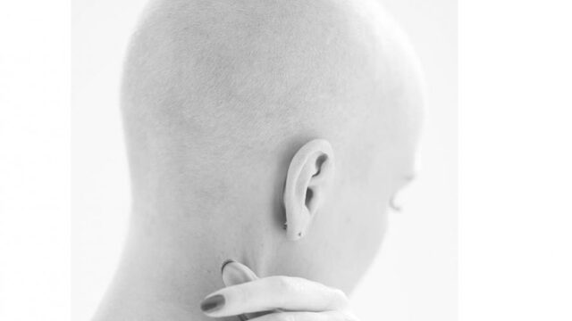 Sandra verloor in 4 dagen al haar haren