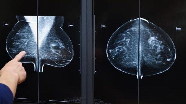 '30 procent van meest voorkomende kankers kan voorkomen worden door gezonder te leven'