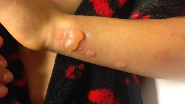 Kinderen lopen flinke brandwonden op door reuzenberenklauw