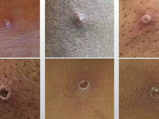 Alledaagse Vragen - Wat voor pokken zijn apenpokken?