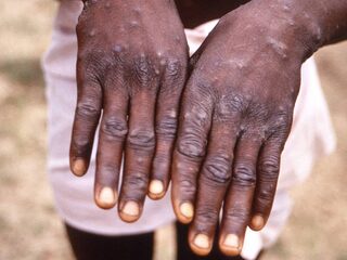 Apenpokkenvirus in Nederland, wordt vooral overgedragen door intensief contact