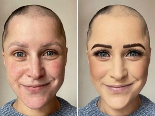 Veronique ging van een volle haardos naar kaal in 2 weken