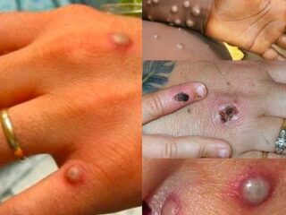 Podcast De Dag: apenpokken, feit en fictie