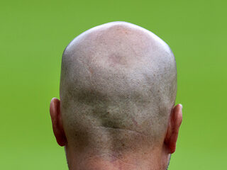 Waarom worden mannen altijd kaal op dezelfde plek?